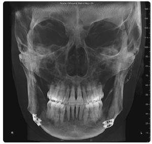 Bone growth